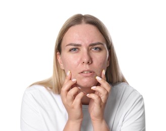 Photo of Woman with acne problem on white background