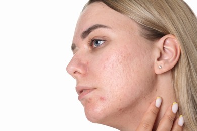 Photo of Woman with acne problem on white background, closeup. Space for text
