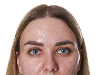 Photo of Woman with acne problem on white background, closeup