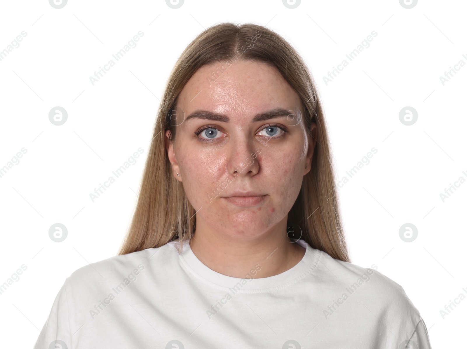 Photo of Woman with acne problem on white background