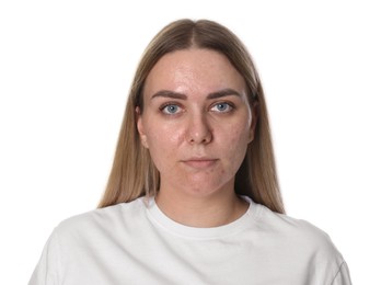 Photo of Woman with acne problem on white background