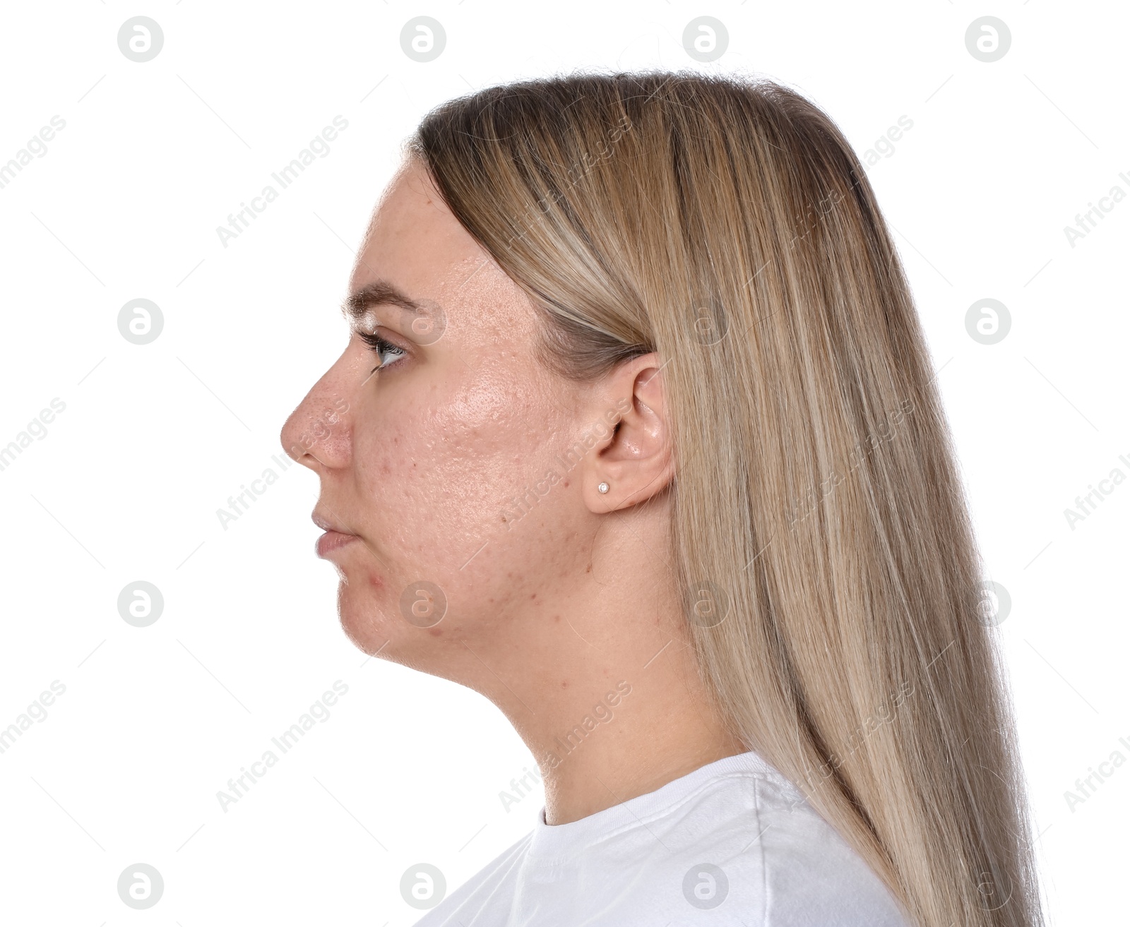 Woman with acne problem on white background Photo of Woman with acne problem on white background