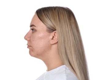 Photo of Woman with acne problem on white background