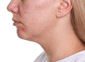 Photo of Woman with acne problem on white background, closeup