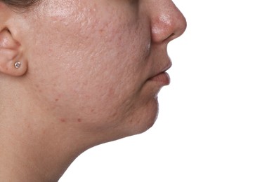 Photo of Woman with acne problem on white background, closeup