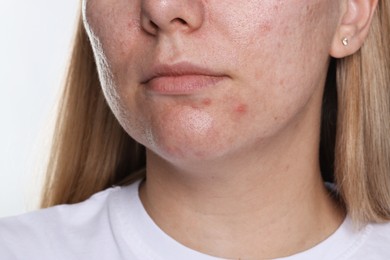 Photo of Woman with acne problem on white background, closeup