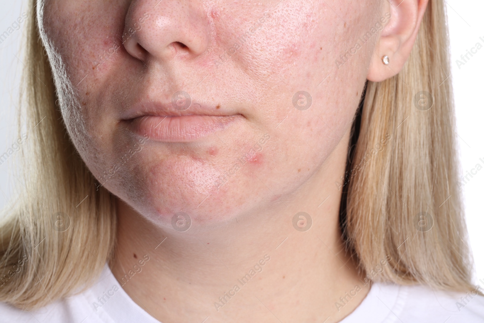 Woman with acne problem on white background, closeup Photo of Woman with acne problem on white background, closeup