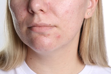Photo of Woman with acne problem on white background, closeup