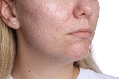 Photo of Woman with acne problem on white background, closeup