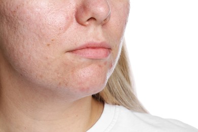 Photo of Woman with acne problem on white background, closeup