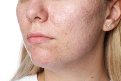 Photo of Woman with acne problem on white background, closeup