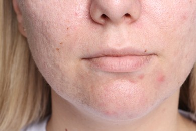 Photo of Closeup view of woman with acne problem