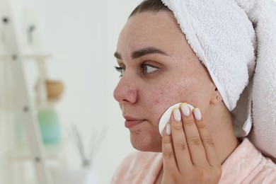 Photo of Woman with acne problem cleaning her face near mirror indoors, space for text