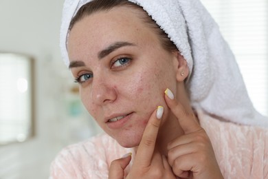 Photo of Woman popping pimple in bathroom. Acne problem