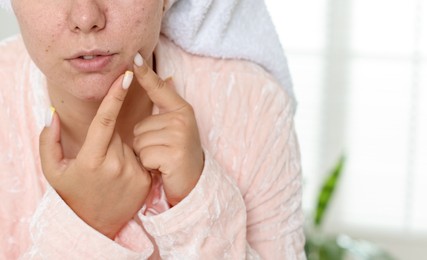 Photo of Woman popping pimple indoors, closeup. Acne problem