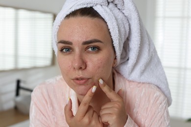 Photo of Woman popping pimple in bathroom. Acne problem