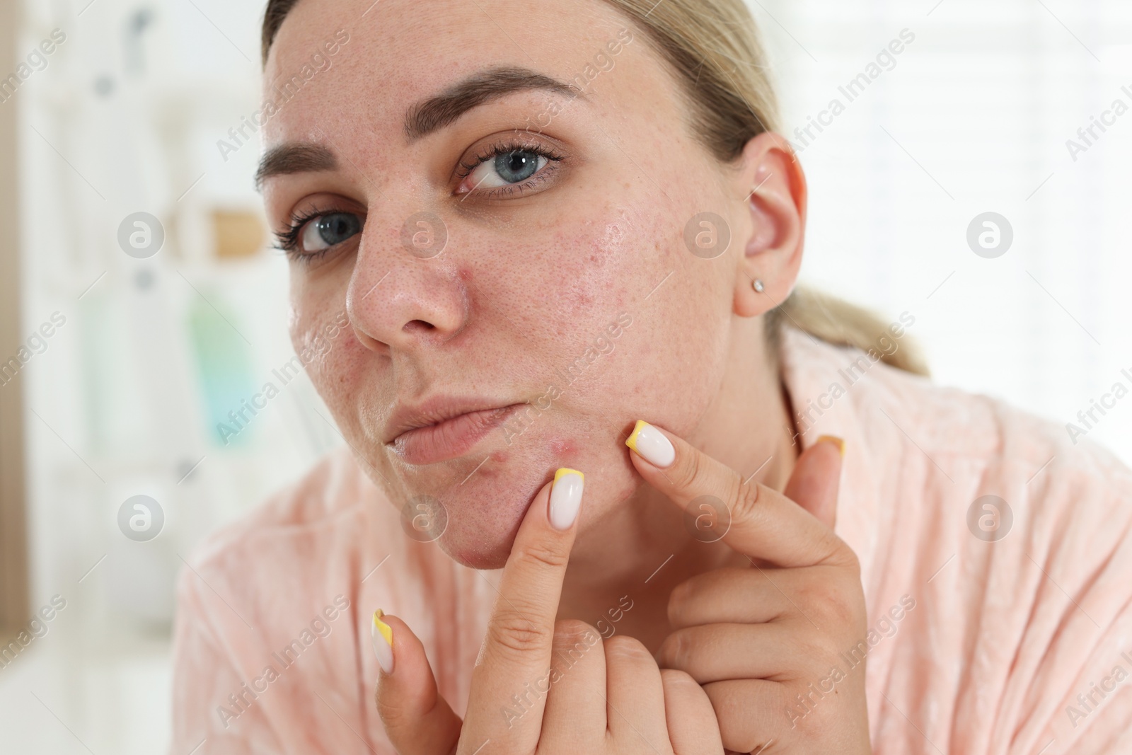 Woman popping pimple at home. Acne problem Photo of Woman popping pimple at home. Acne problem