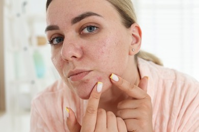 Photo of Woman popping pimple at home. Acne problem
