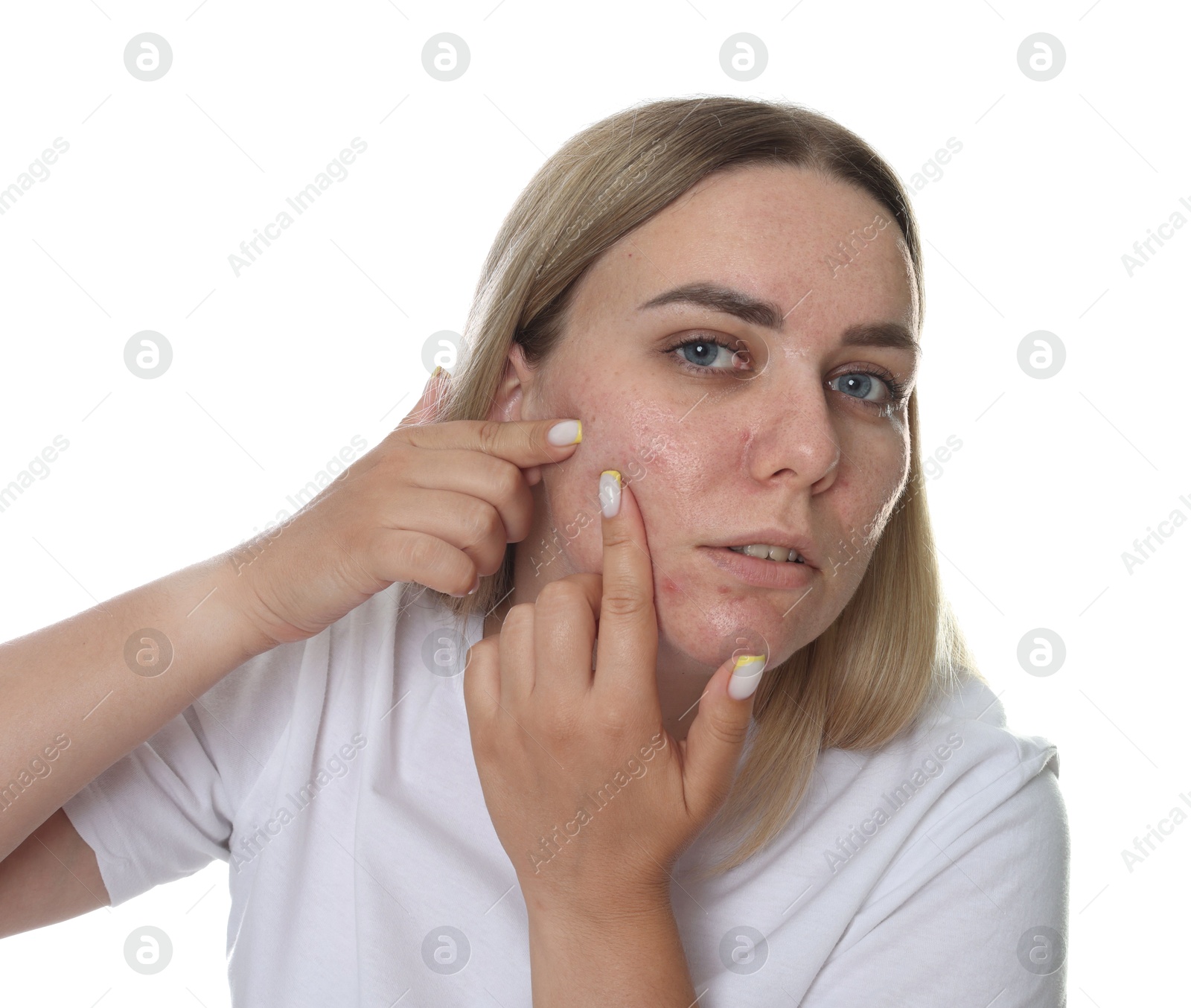 Woman with acne problem on white background Photo of Woman with acne problem on white background