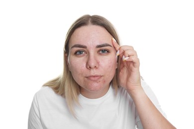 Photo of Woman with acne problem on white background
