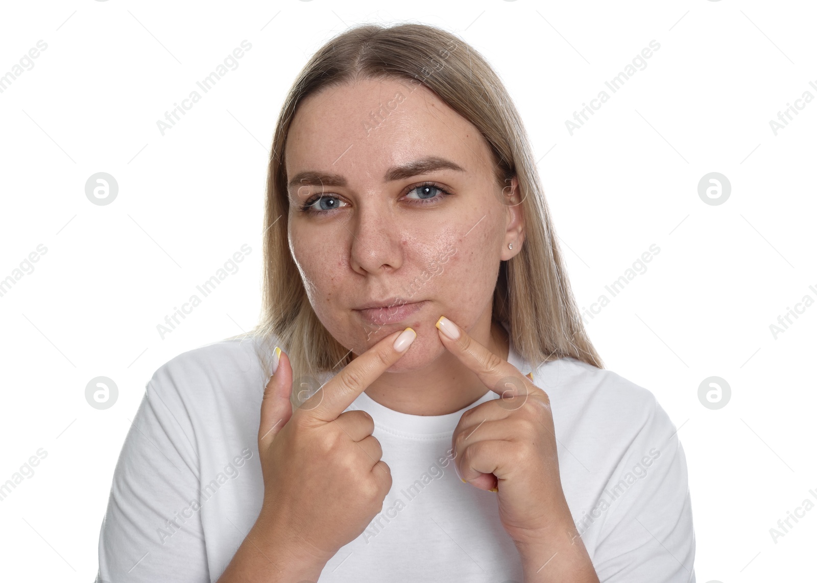 Woman popping pimple on white background. Acne problem Photo of Woman popping pimple on white background. Acne problem