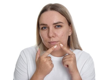 Photo of Woman popping pimple on white background. Acne problem