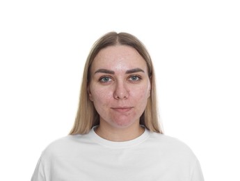 Photo of Woman with acne problem on white background