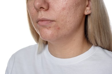 Photo of Woman with acne problem on white background, closeup