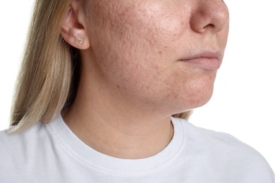 Photo of Woman with acne problem on white background, closeup