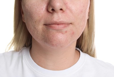 Photo of Woman with acne problem on white background, closeup