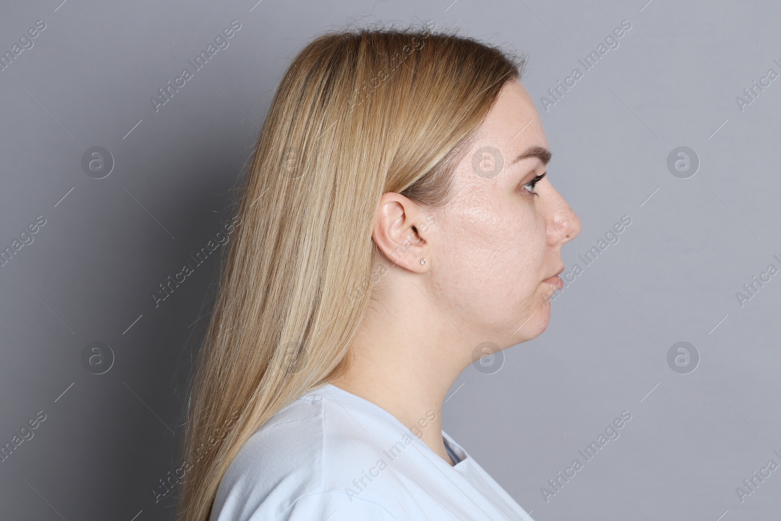 Beautiful woman with acne problem on grey background Photo of Beautiful woman with acne problem on grey background