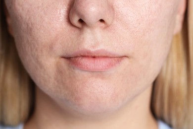 Photo of Closeup view of woman after cosmetic procedure