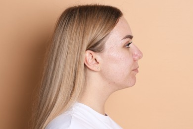 Photo of Beautiful woman with acne problem on beige background