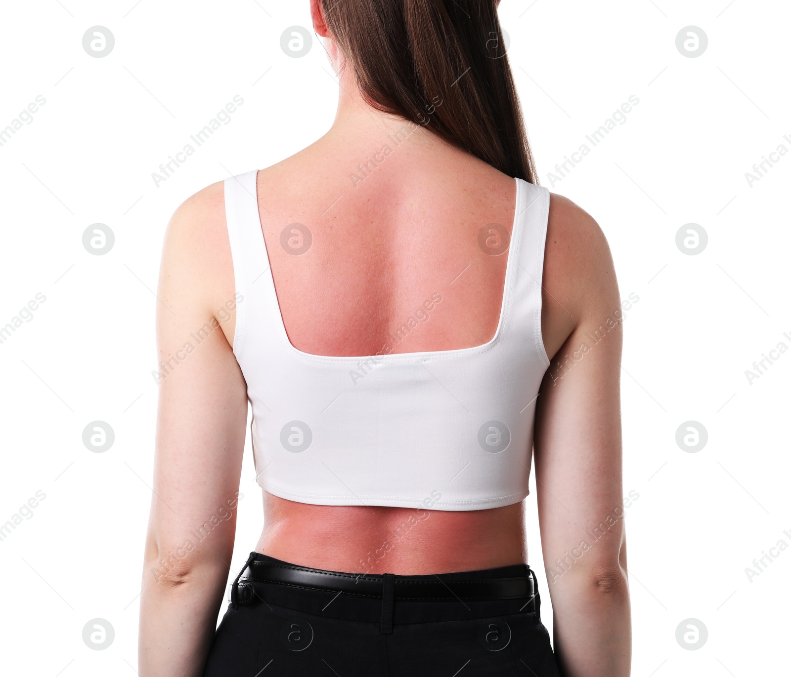 Woman with sunburned skin on white background, back view Photo of Woman with sunburned skin on white background, back view