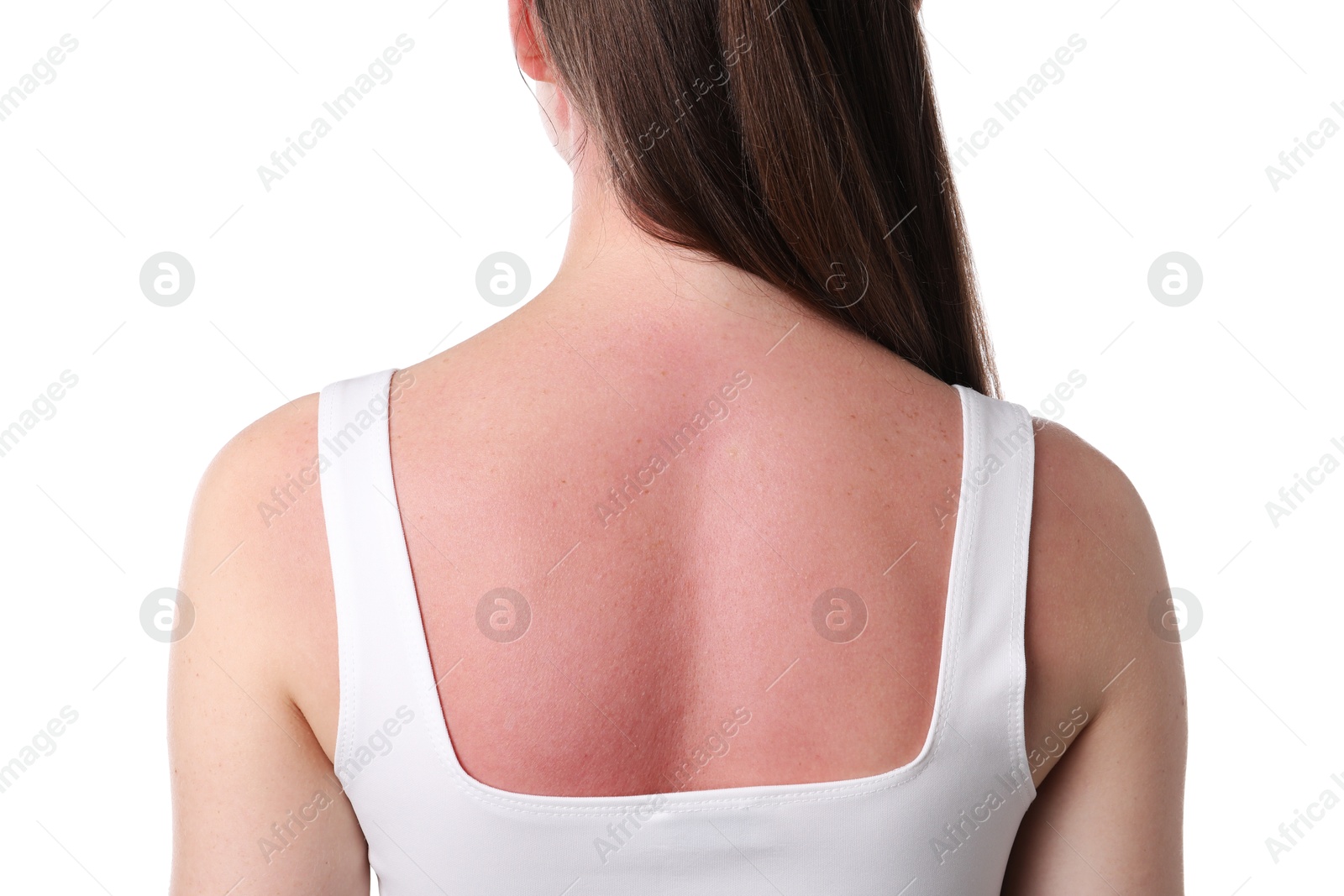 Woman with sunburned skin on white background, back view Photo of Woman with sunburned skin on white background, back view