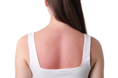 Photo of Woman with sunburned skin on white background, back view