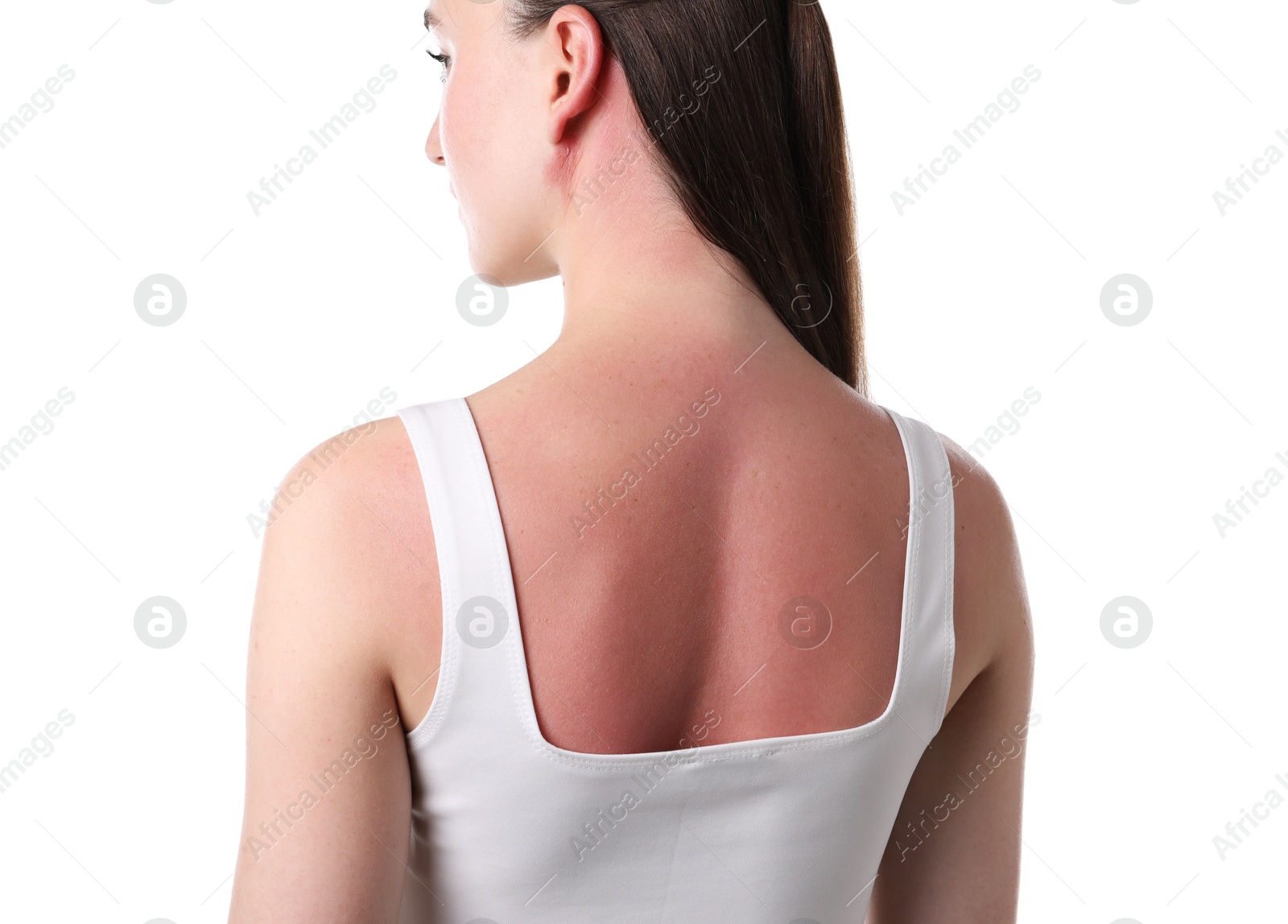 Woman with sunburned skin on white background Photo of Woman with sunburned skin on white background