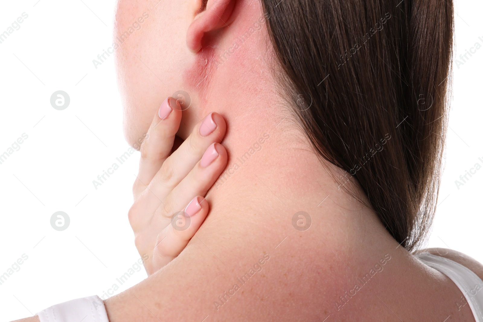 Photo of Woman with sunburned skin on white background, closeup