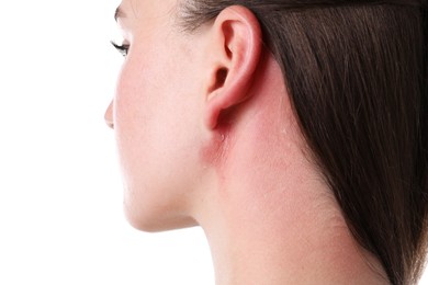 Photo of Woman with sunburned skin on white background, closeup