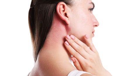 Photo of Woman with sunburned skin on white background, closeup
