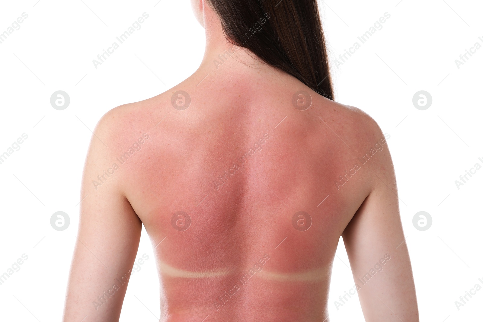 Woman with sunburned skin on white background, back view Photo of Woman with sunburned skin on white background, back view