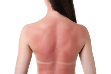 Photo of Woman with sunburned skin on white background, back view