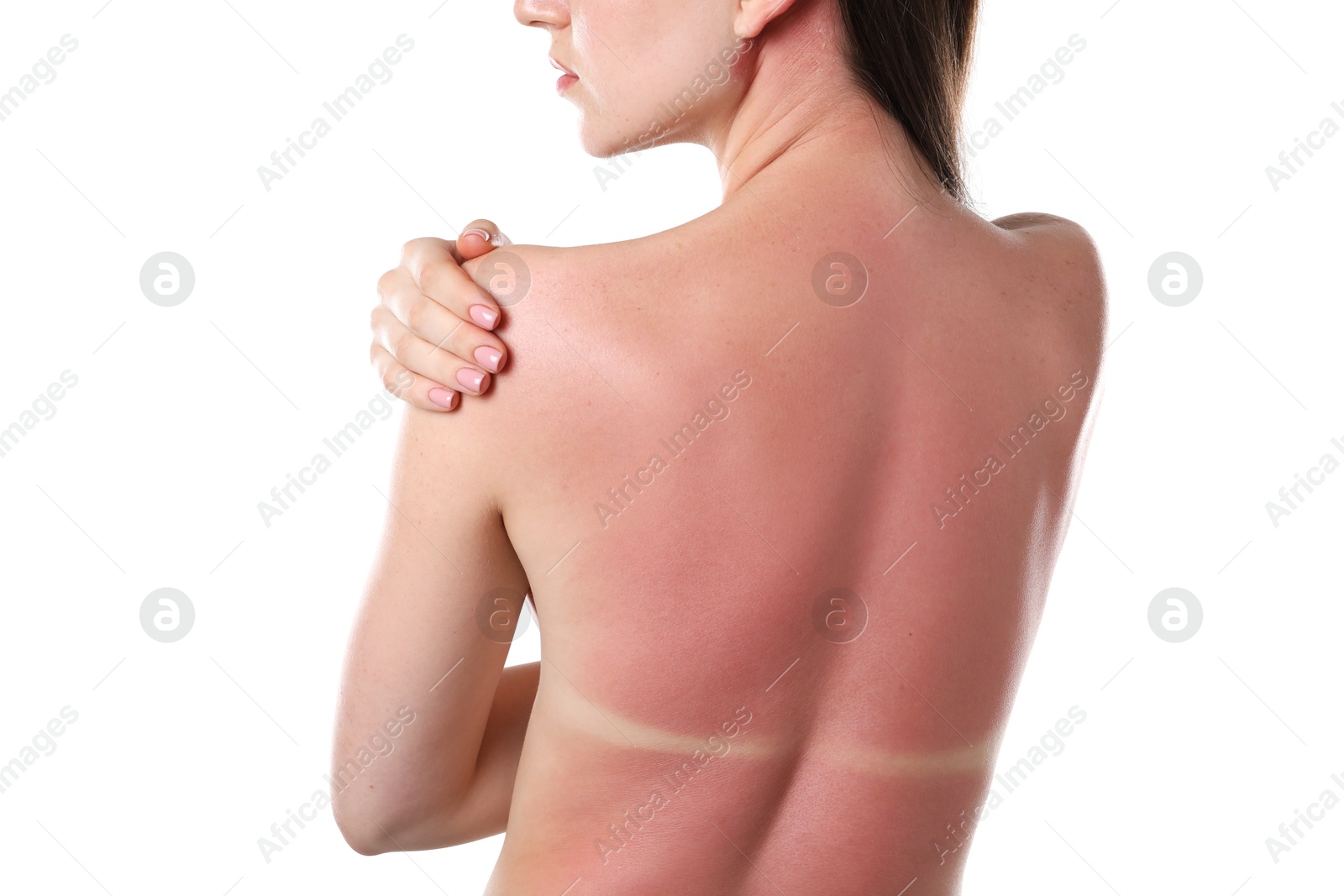 Woman with sunburned skin on white background, back view Photo of Woman with sunburned skin on white background, back view