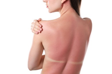 Photo of Woman with sunburned skin on white background, back view