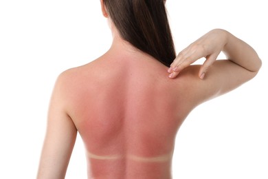Photo of Woman with sunburned skin on white background, back view