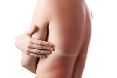 Photo of Woman with sunburned skin on white background, closeup
