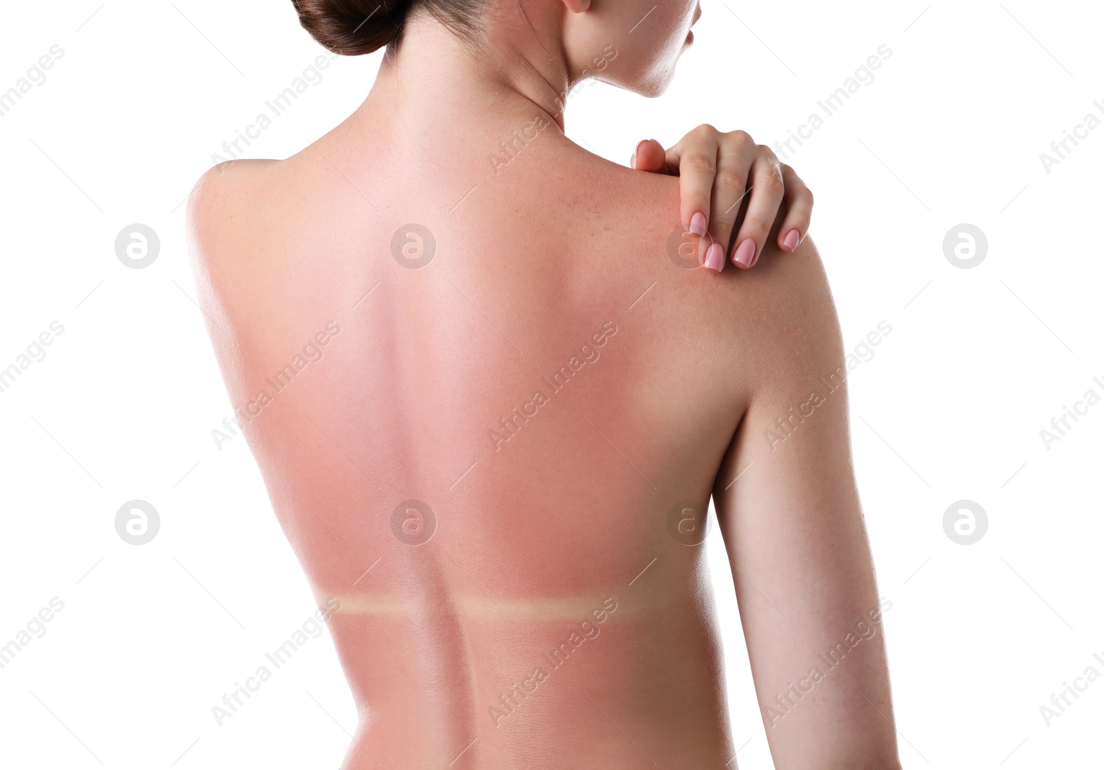 Woman with sunburned skin on white background, back view Photo of Woman with sunburned skin on white background, back view