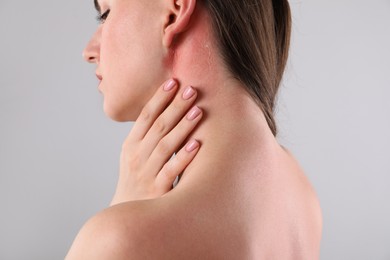 Photo of Woman with sunburned skin on grey background, closeup