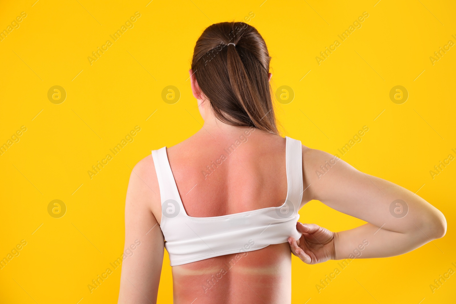 Woman with sunburned skin on orange background, back view Photo of Woman with sunburned skin on orange background, back view