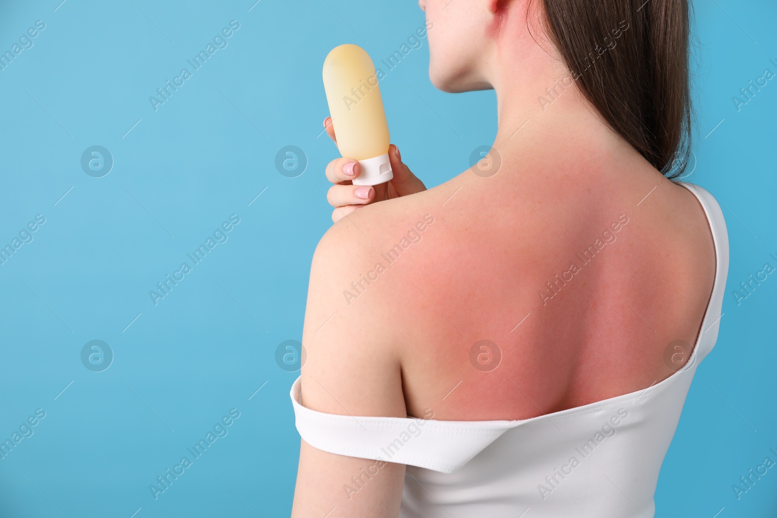 Woman with sunburned skin holding bottle of sun protection product on light blue background, closeup. Space for text Photo of Woman with sunburned skin holding bottle of sun protection product on light blue background, closeup. Space for text
